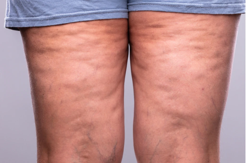 Lipœdème et chirurgie : ce que les patients doivent vraiment savoir